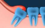 Воспаление десны около зуба у ребенка лечение в домашних условиях