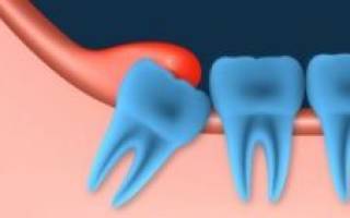 Воспаление десны около зуба у ребенка лечение в домашних условиях
