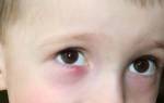 Гной из глаз у ребенка 2 года лечение