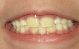 Желтые зубы у ребенка 7 лет причины и лечение комаровский