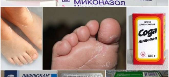 Грибок у ребенка между пальцами ног лечение в домашних условиях