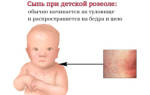 Сыпь у ребенка на животе и спине без температуры лечение