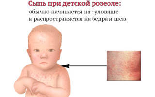 Сыпь у ребенка на животе и спине без температуры лечение