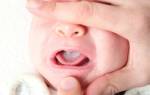 Лечение молочницы у ребенка 2 лет во рту