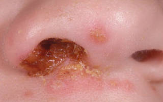 Болячки в носу у ребенка причины и лечение