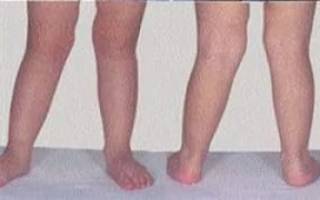 Одна нога короче другой на 1 см у ребенка лечение