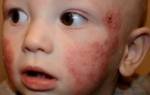 Диатез на щеках у ребенка 5 месяцев лечение