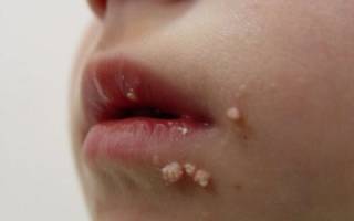 Папиллома у ребенка на лице причины и лечение