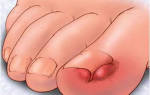 Панариций пальца ноги у ребенка лечение в домашних условиях