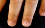 Почему слезают ногти на руках у ребенка лечение?