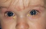 Красные глаза и гной у ребенка причины и лечение