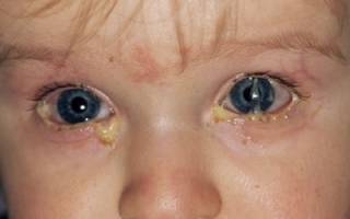Красный глаз с гноем у ребенка причины и лечение