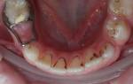 Налет на зубах у ребенка 8 лет причины и лечение