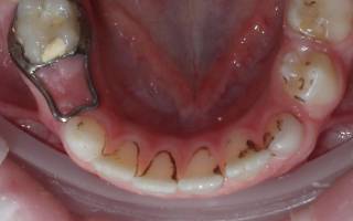 Налет на зубах у ребенка 8 лет причины и лечение