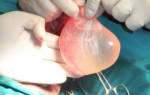 Водянка яичка у ребенка причины и лечение операция в минске