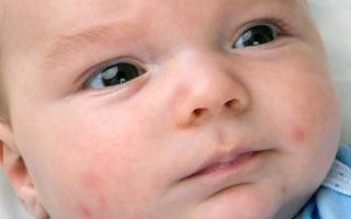 Сыпь на лице у ребенка 1 месяц лечение