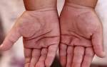 Трескается кожа на пальцах рук у ребенка причины и лечение