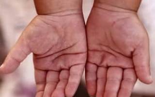 Трескаются пальцы у ребенка на руках причины и лечение