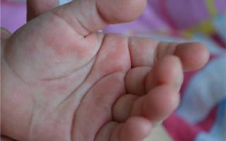 Сильно чешутся ладони рук у ребенка причины лечение
