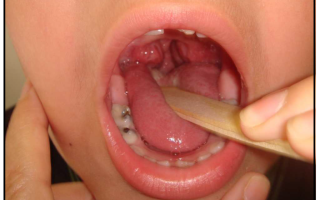 Запах изо рта при аденоидах у ребенка лечение