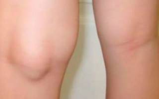 Киста беккера под коленом у ребенка причины и лечение