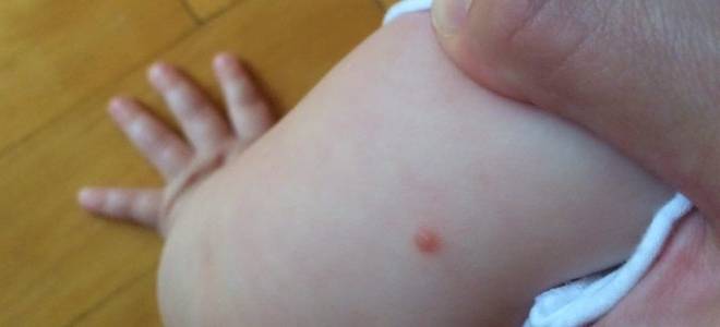 Гнойные прыщи на руках у ребенка причины и лечение