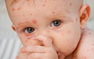 Аллергия на лице красные пятна чешутся лечение у ребенка