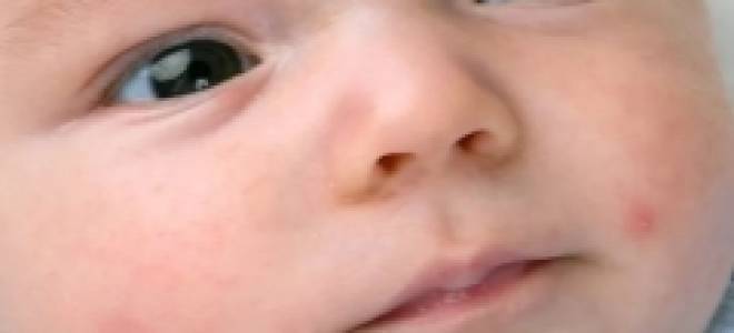 Волдыри на руках и ногах у ребенка чешутся лечение