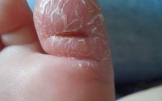 Трещины на пальцах ног у ребенка причины и лечение