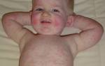 Сыпь на теле у ребенка причины и лечение