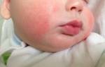 Как выглядит аллергия у ребенка на коже лечение?