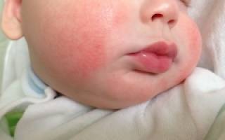 Аллергия у ребенка на коже как выглядит