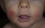 Дерматит на лице у ребенка лечение в домашних условиях