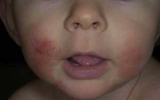 Дерматит на лице у ребенка лечение в домашних условиях