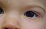 Слезится глаз у ребенка 3 года лечение комаровский