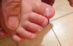 Слоение ногтей на руках причины и лечение у ребенка