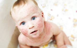 Дерматит у ребенка на лице причины и лечение