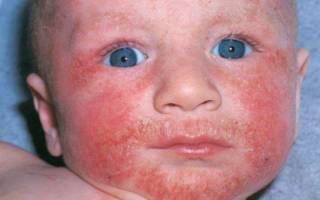 Аллергия на белок коровьего молока у ребенка симптомы и лечение