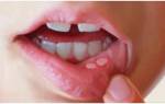 Язвочки на внутренней стороне губы у ребенка лечение