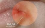 Трещины в уголках губ у ребенка причины лечение комаровский