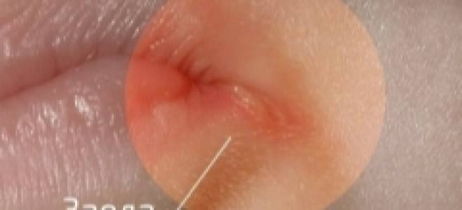 Трещины в уголках губ у ребенка причины лечение комаровский