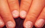 Белые полоски на ногтях рук причины и лечение у ребенка