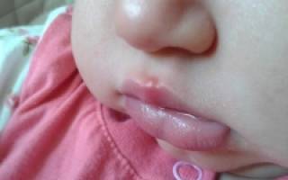 Герпес на губах у ребенка до года лечение опасно ли
