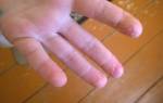 Слезает кожа с пальцев рук у ребенка лечение