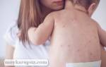 Моллюск на коже у ребенка причины и лечение