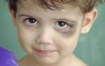 У ребенка синяк под глазом от удара лечение