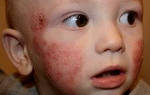 Атопический дерматит у ребенка – что это?