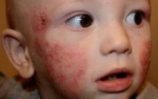 Атопический дерматит у ребенка – что это?