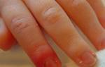 Панариций пальца на руке у ребенка лечение в домашних условиях