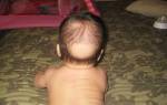 Выпадают волосы у ребенка 3 лет причины и лечение